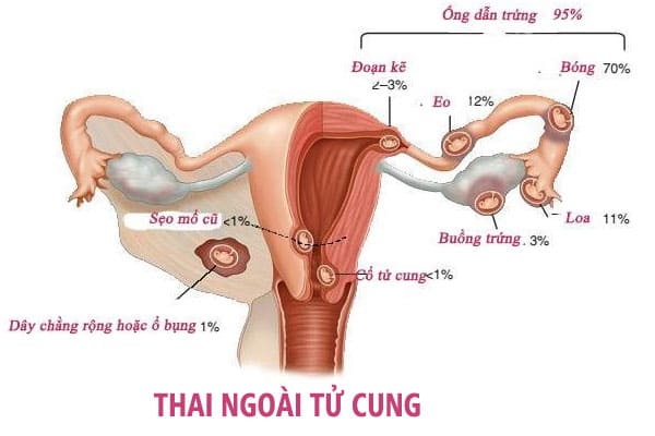 Thai ngoài tử cung là tình trạng nguy hiểm đối với mẹ bầu