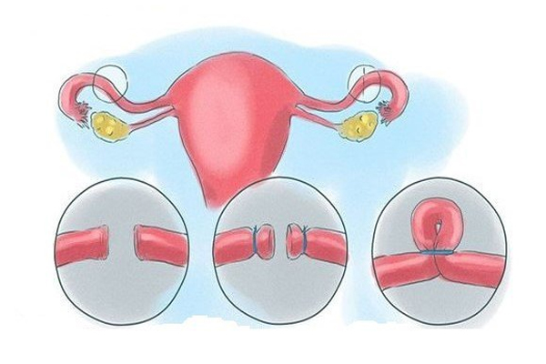 Thắt ống dẫn trứng để trứng không thể di chuyển vào tử cung