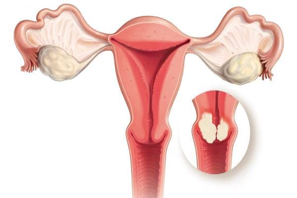 Phì đại cổ tử cung là hiện tượng cổ tử cung phình to lên gấp 2 - 4 lần bình thường