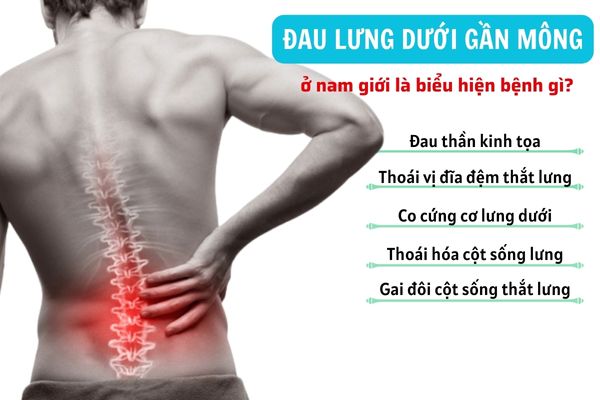 Bị đau lưng dưới gần mông ở nam giới là biểu hiện bệnh gì?