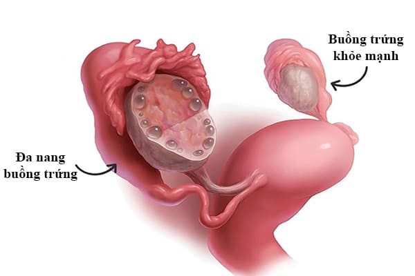 Nữ giới bị trễ kinh 1 tháng có thể là dấu hiệu của bệnh đa nang buồng trứng