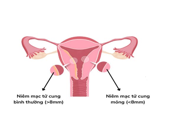 Hình ảnh về niêm mạc tử cung mỏng