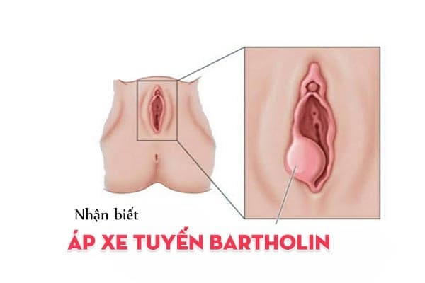 Hình ảnh về bệnh áp xe tuyến bartholin