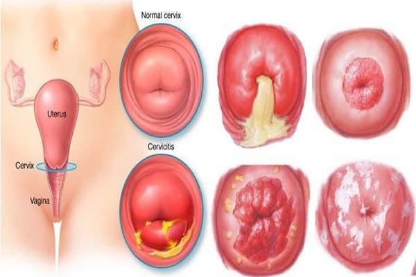 Viểm cổ tử cung là nguyên nhân dẫn đến bệnh vô sinh, hiếm muộn ở nữ giới