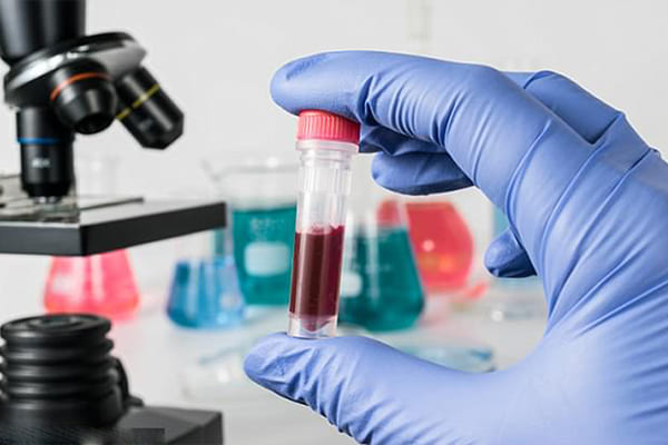 Xét nghiệm máu giúp phát hiện virus HPV gây bệnh sùi mào gà